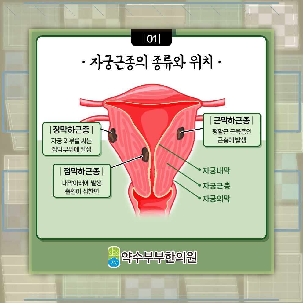 자궁근종의 변화 양상에 맞춘 주기적인 관리 방법