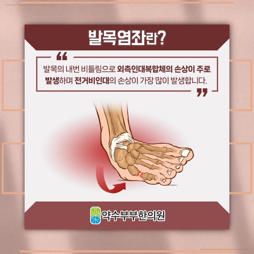 발목염좌 후 남은 부기와 통증, 회복 과정에서 살펴볼 점